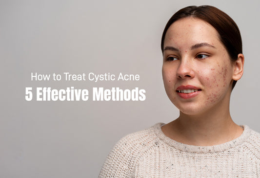 How to Treat Cystic Acne: 5 Effective Methods